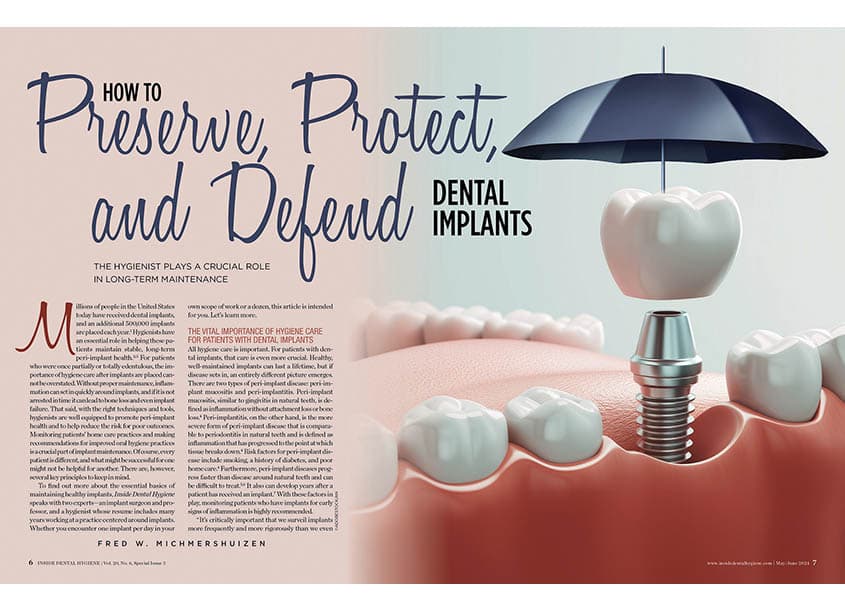 How to Preserve, Protect, and Defend Dental Implants