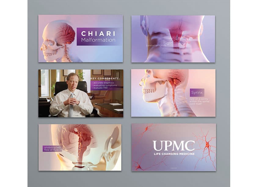 Chiari Malformation Motion Graphics