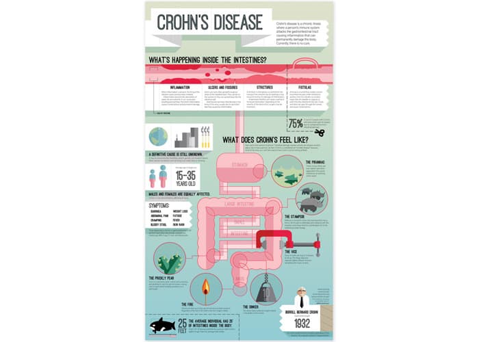 Crohn’s Disease Infographic